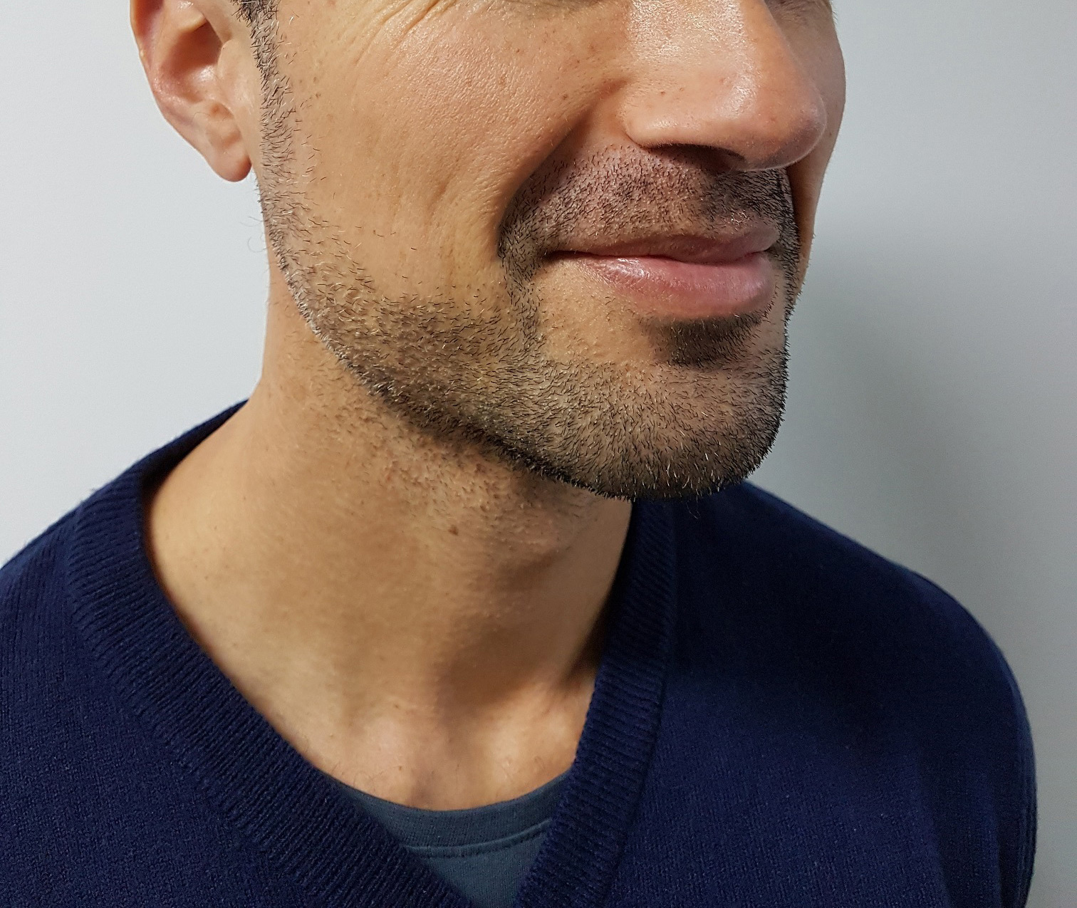1.5 mm beard